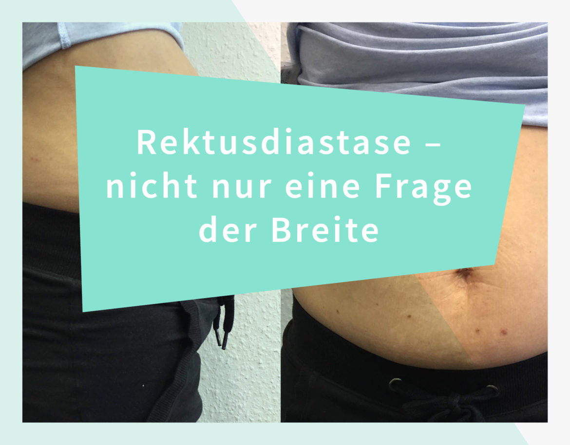 Rektusdiastase - nicht nur eine Frage der Breite