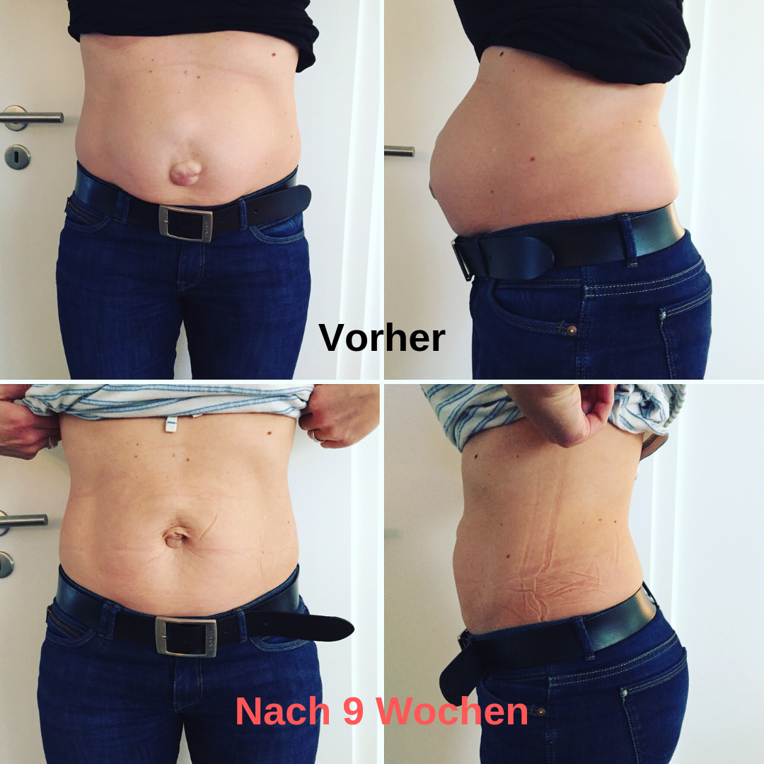 Nabelbruch Op Vorher Nachher Bilder